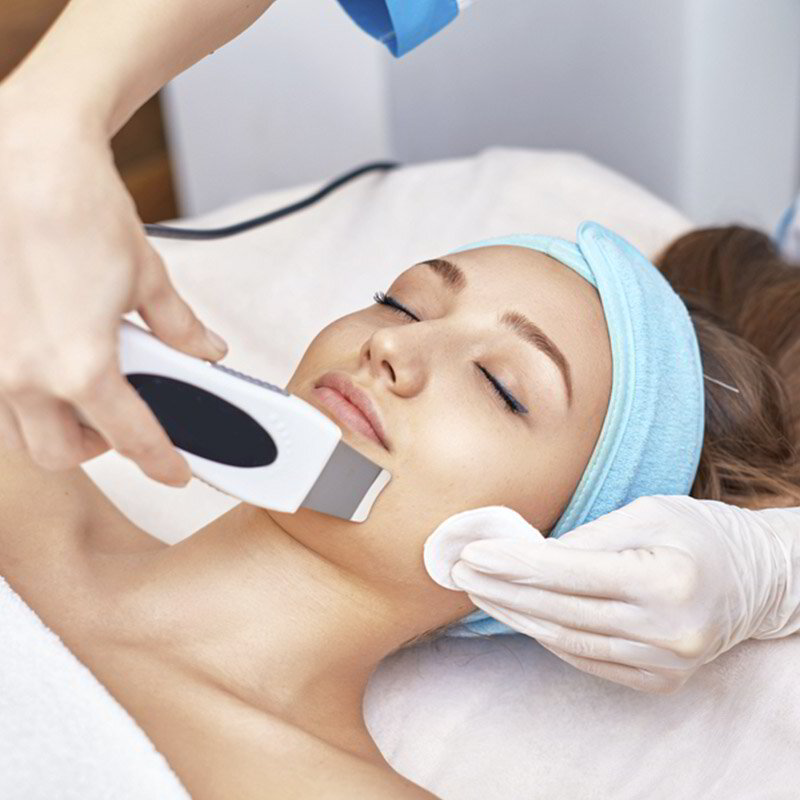 Peeling Químico Precio Tratamiento Luz Pulsada Peeling Luz Pulsada