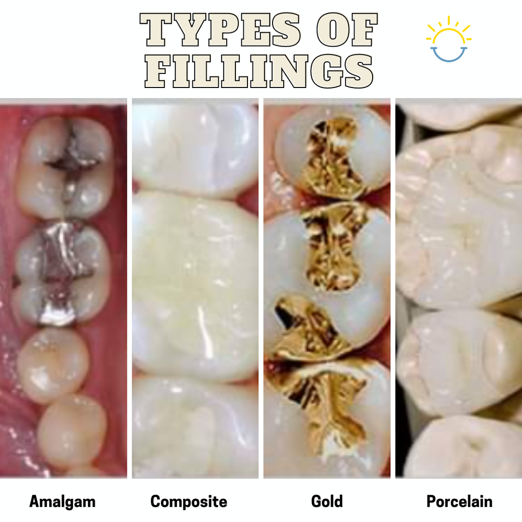 why-are-dental-fillings-so-important