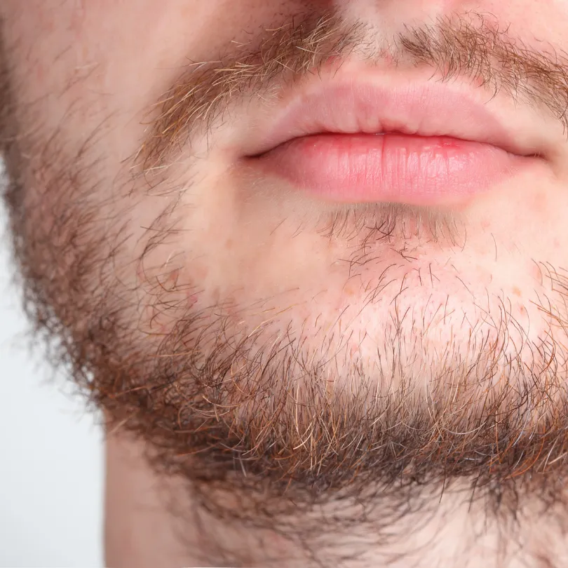 Microinjerto de Barba