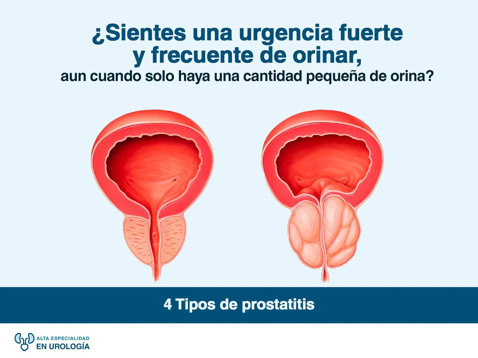 4 Tipos de Prostatitis