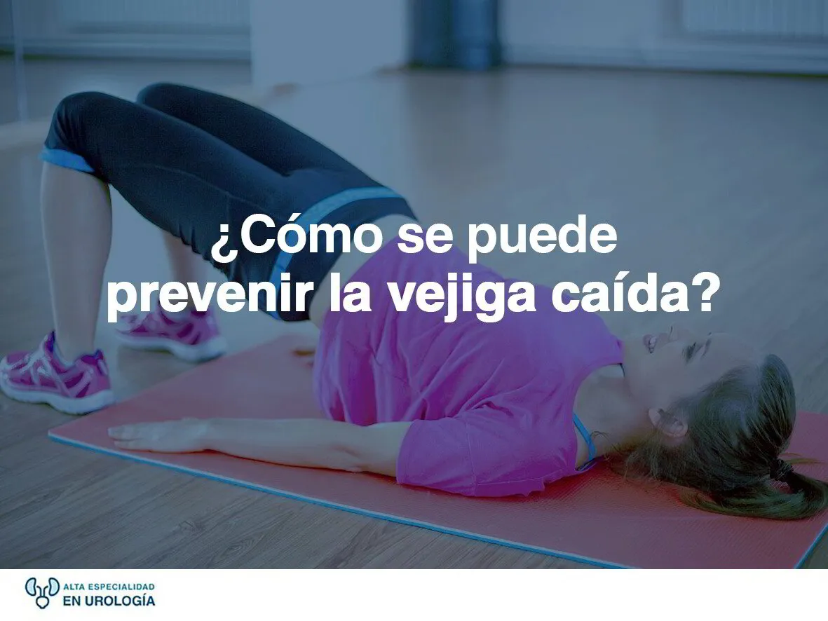 ¿Cómo se puede prevenir la vejiga caída o Cistocele?