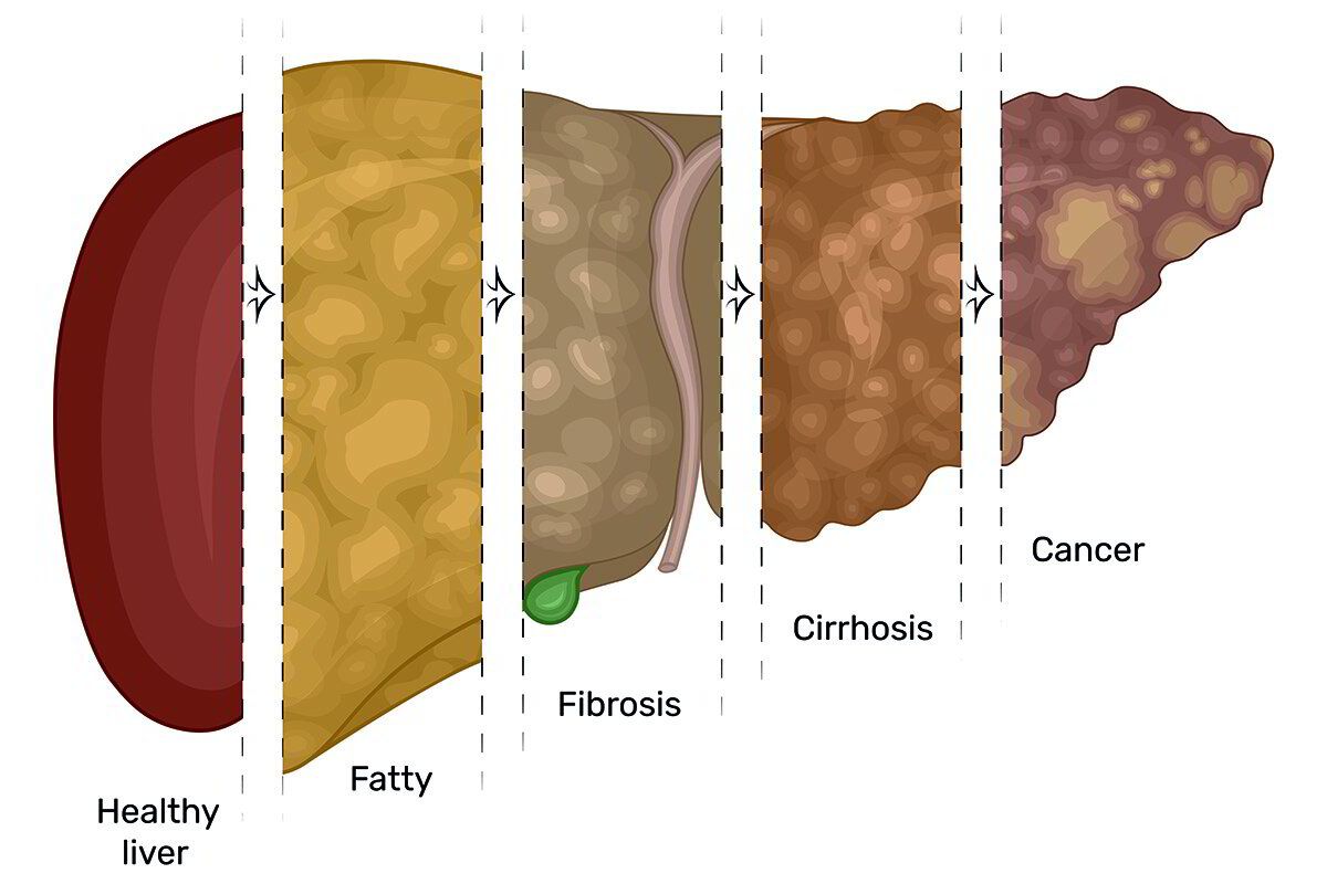 LIVER HEALTH