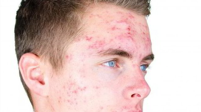 demelan cream for dark spots