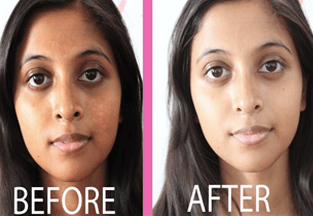 demelan cream for acne scars