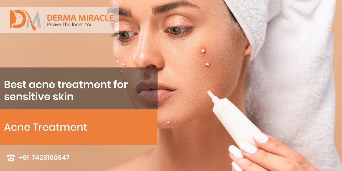 Best acne treatment for sensitive skin