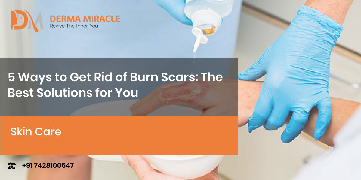 5 Ways to Get Rid of Burn Scars The Best Solutions for You