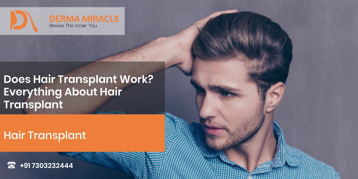 Does Hair Transplant Work? Everything About Hair Transplant