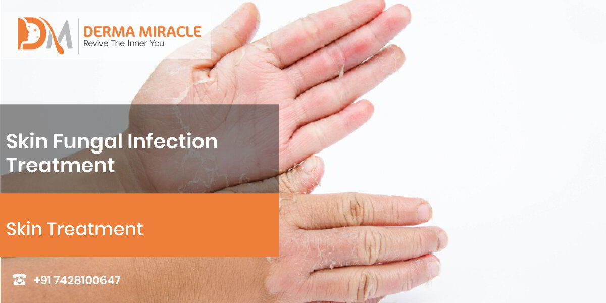 Skin Fungal Infection Treatment