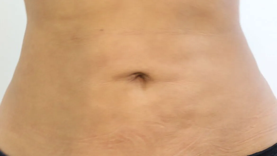 FIBROSIS AFTER A COSMETIC PROCEDURE