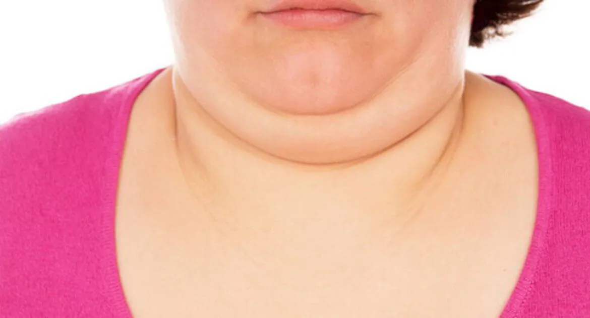 WHAT IS DOUBLE CHIN OR SMARTPHONE SYNDROME?