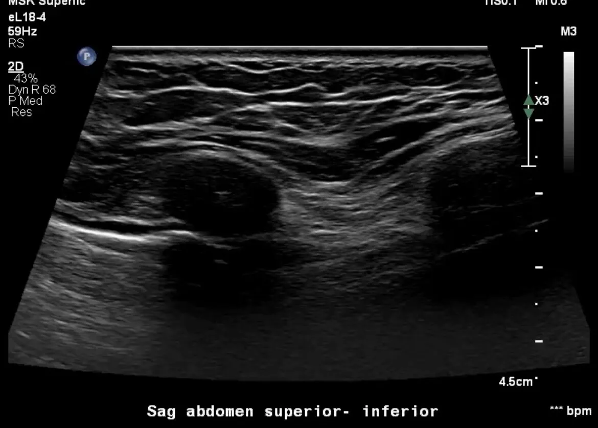 Do you want to know how to scan the ribs using ultrasound?