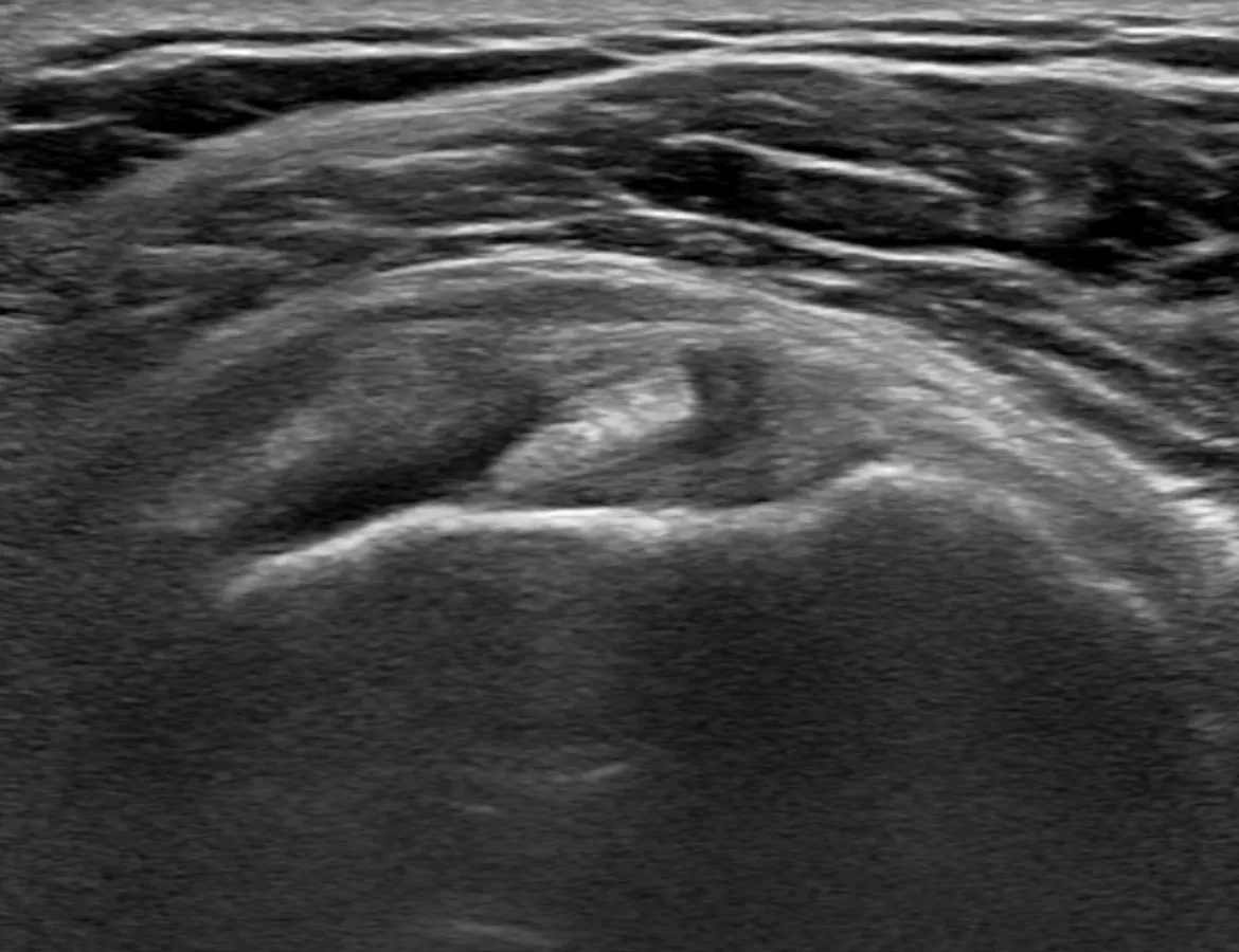 Do you know the anatomy of the rotator interval of the shoulder?