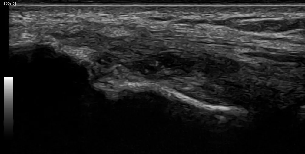 What are 6 sonographic features of tennis elbow?