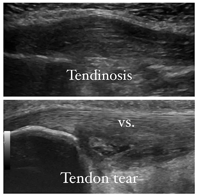 What characteristics help distinguish the appearance of tendinosis from a tendon tear on ultrasound?