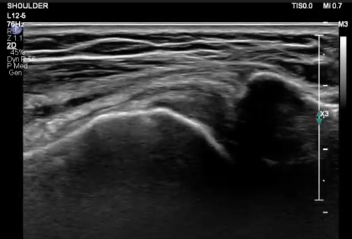 How Use Ultrasound To Adhesive