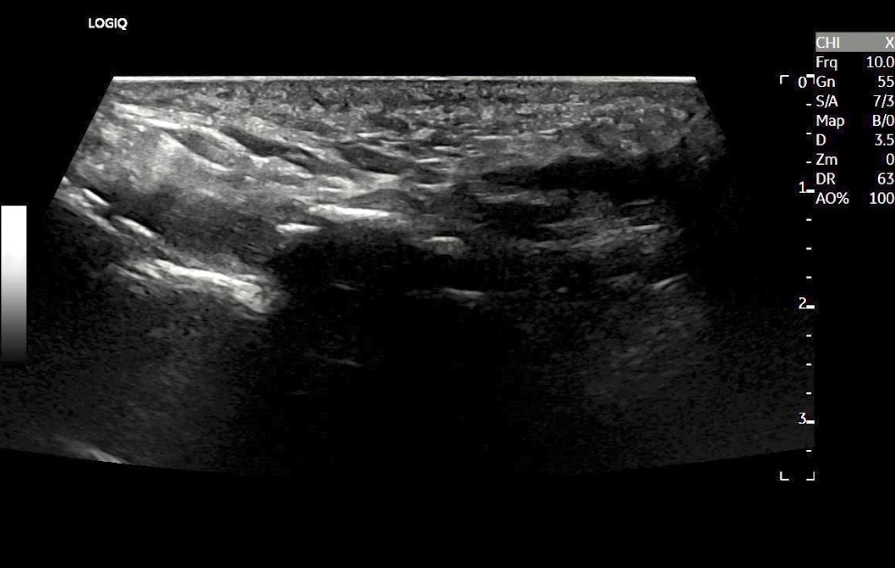 How To Detect The Presence Of Accessory Ossicles During MSK Procedures