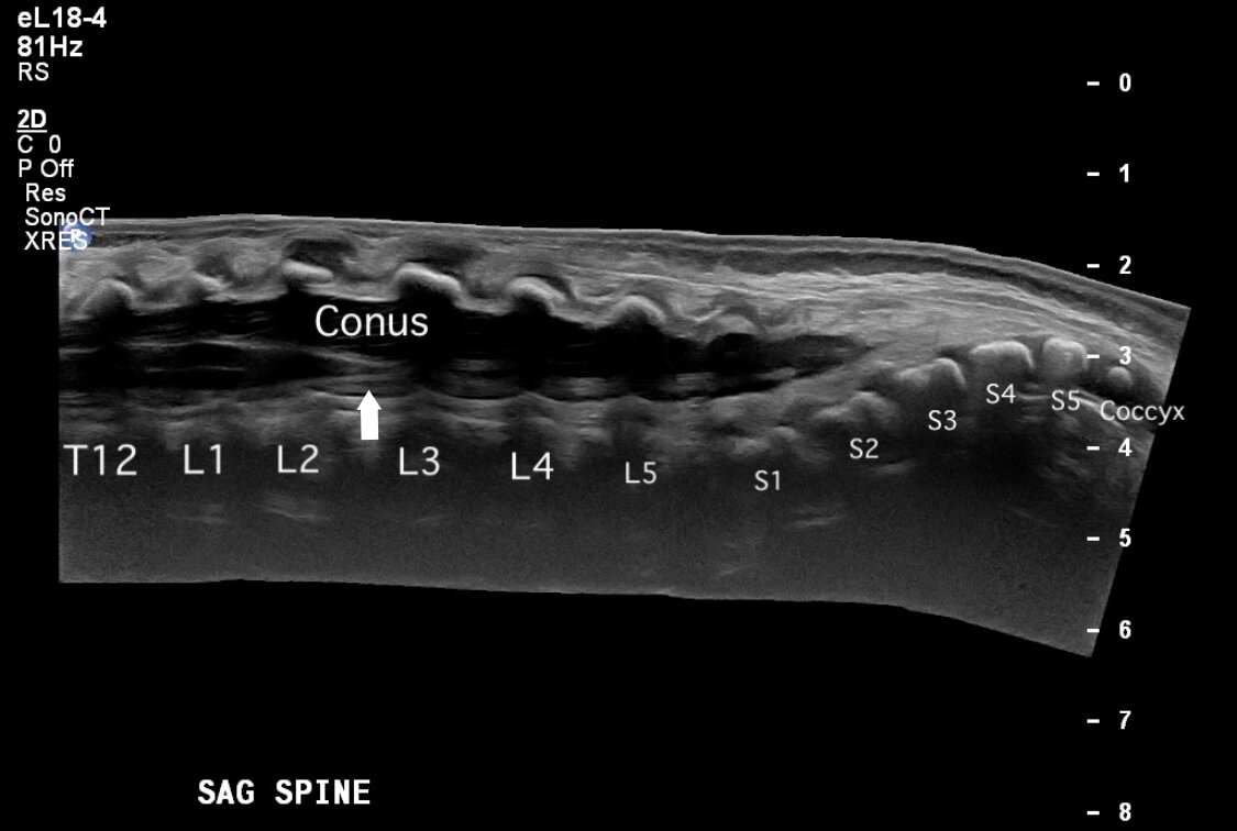 3Step Framework to Successful Pediatric Spinal Ultrasound