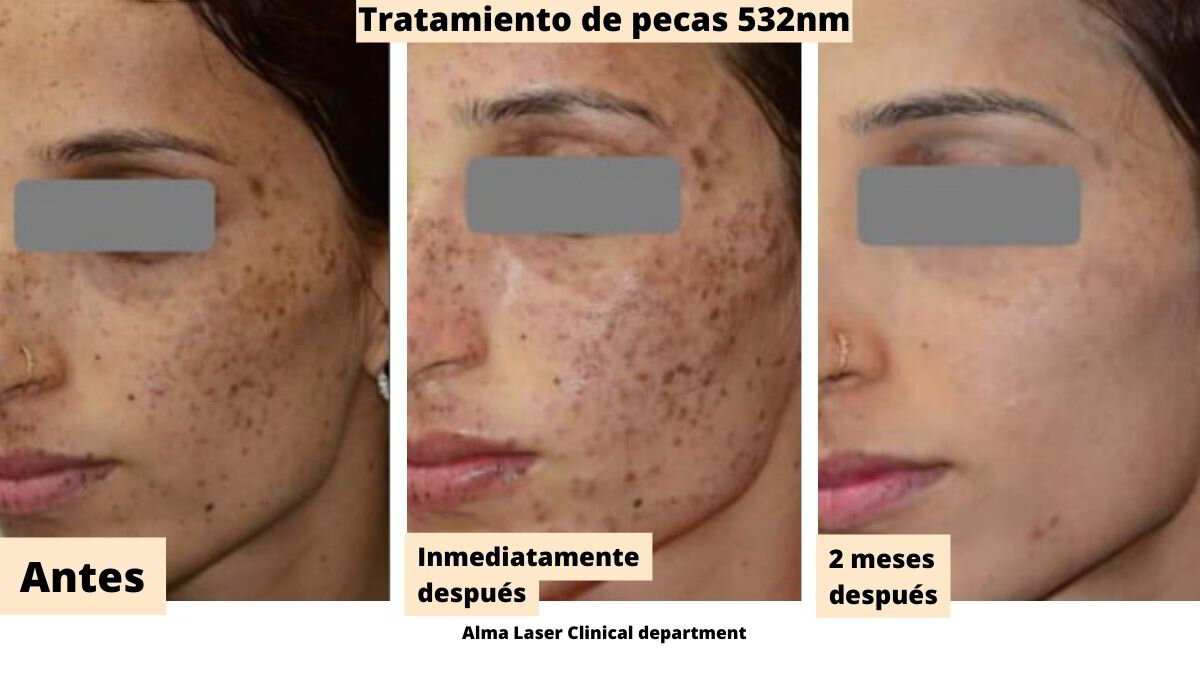 Despidiendote de las Manchas Descubre el Tratamiento con Laser e IPL